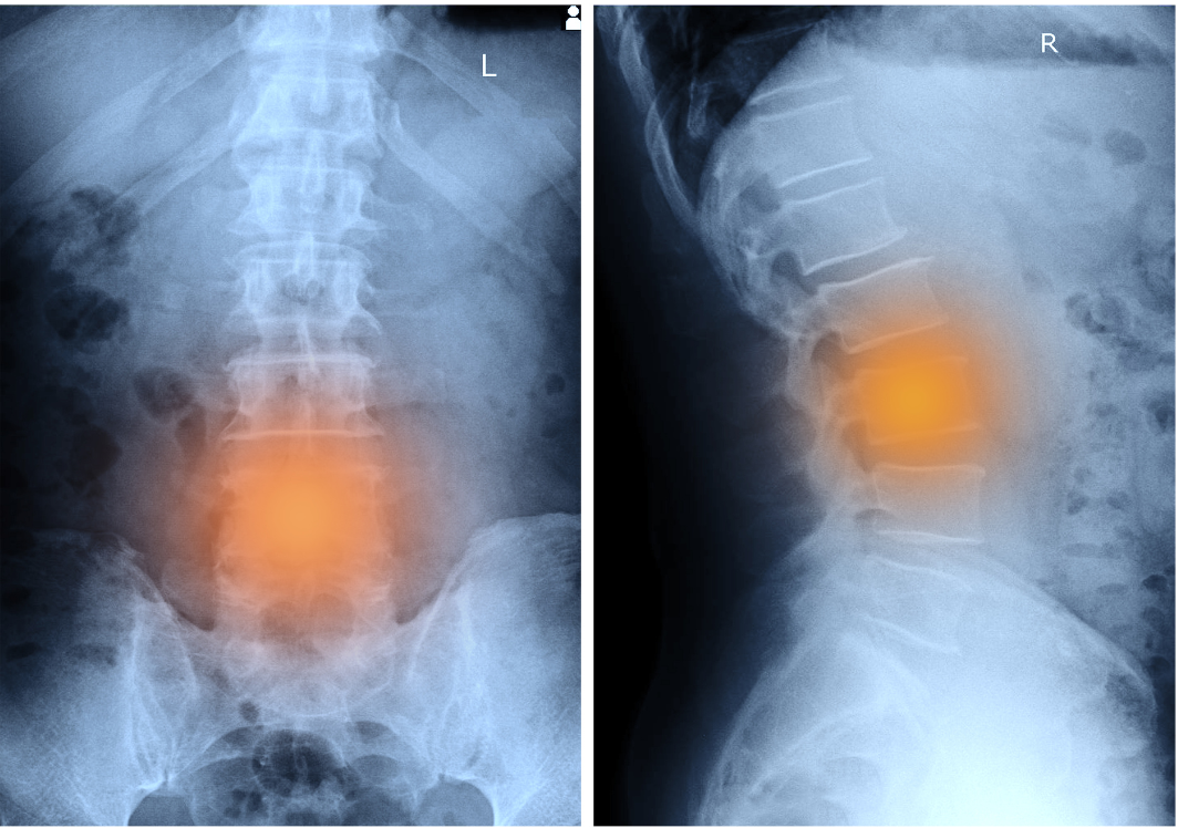 Degenerative Disc Disease  Spinal Decompression Livermore