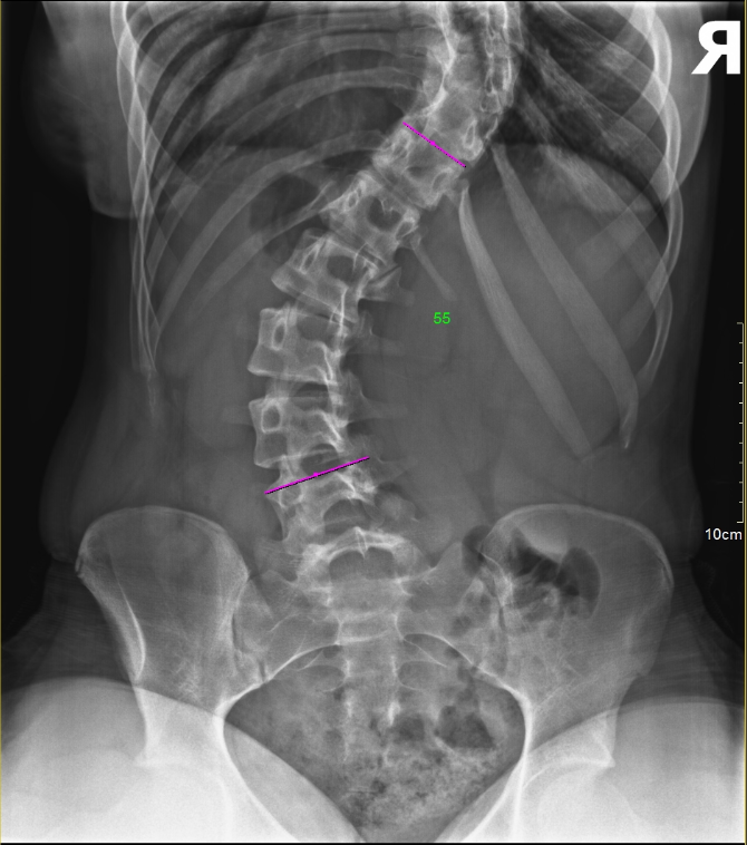 "Isn't Everyone's Spine a Little Crooked?" Myth or Truth?! Part 2: Why You Should Care