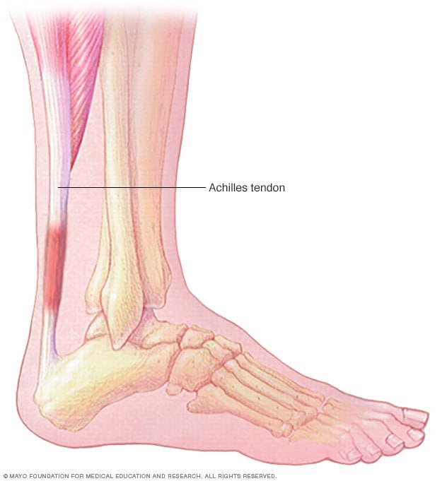 Achilles tendinitis 